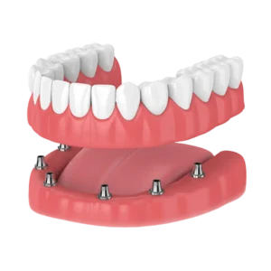 Implant-Supported Dentures
