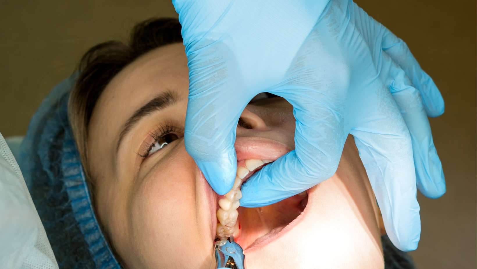 Wisdom Tooth Removal