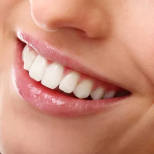 Teeth whitening in an hour