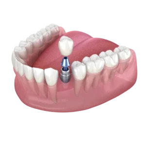 Single Tooth Replacement