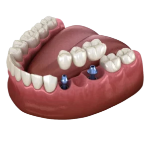 Multiple Teeth Replacement