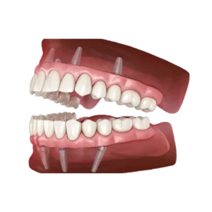Full Arch Replacement