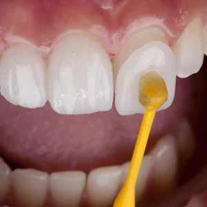 Porcelain Veneers