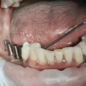 Intra-oral welding