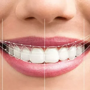 Smile Makeover