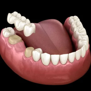 Dentures