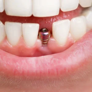 Same-day implants