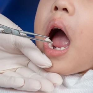 Tooth Removal