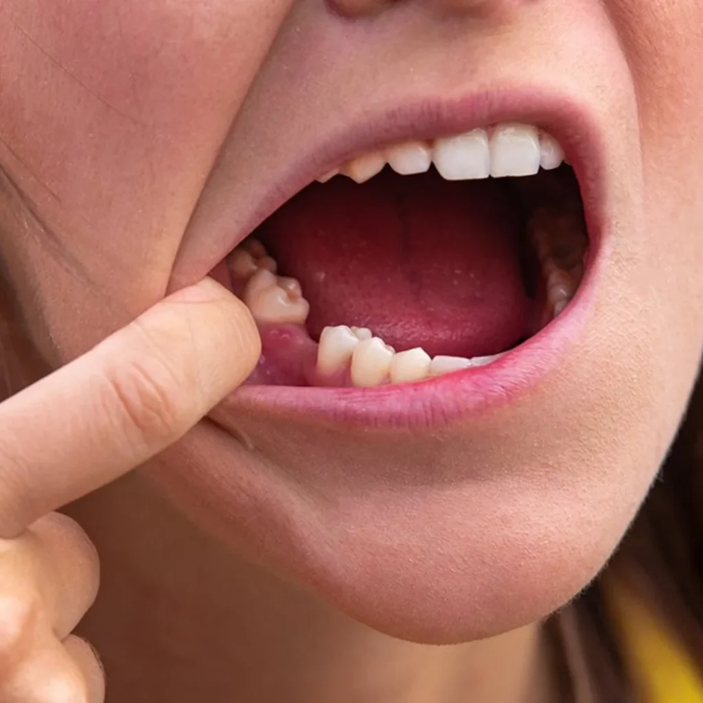 Missing Teeth Treatment
