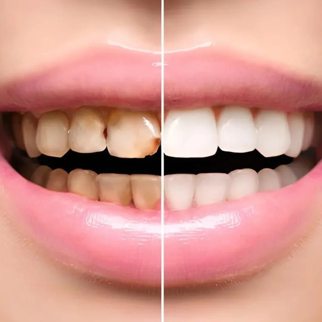 Veneers and Laminates