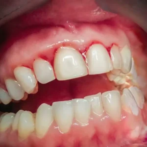 TEETH STRAIGHTENING