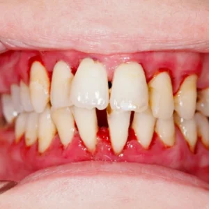 Periodontitis