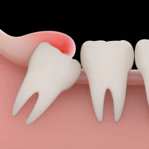 Fully Erupted Wisdom Teeth