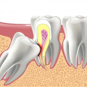 Impacted Wisdom Teeth
