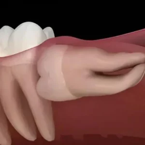 Partially Erupted Wisdom Teeth