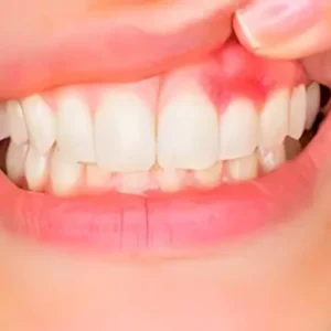 Gum Disease