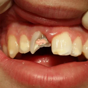 Cracked or Fractured Teeth