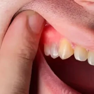 Dental Abscess