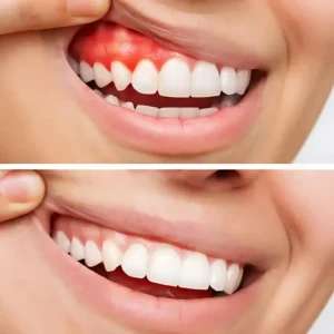 Gum Disease Treatment
