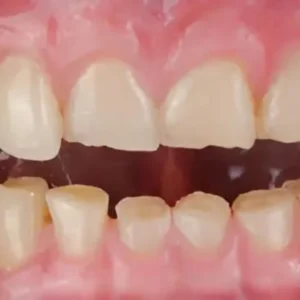 Bruxism (Teeth Grinding)