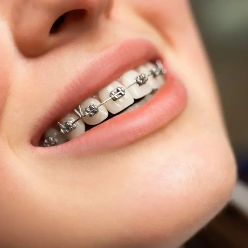 Metal Braces