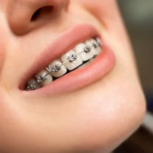 Metal Braces