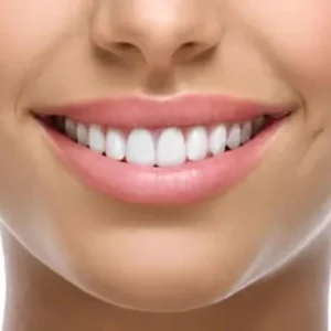 Same-day veneers