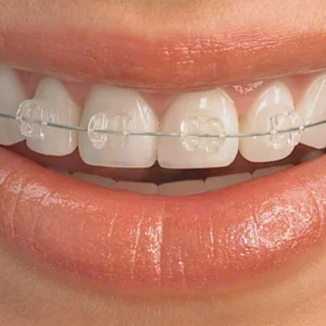 Ceramic Braces