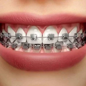 Ceramic Self-Ligating Braces
