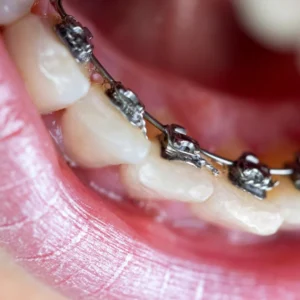 Lingual Braces