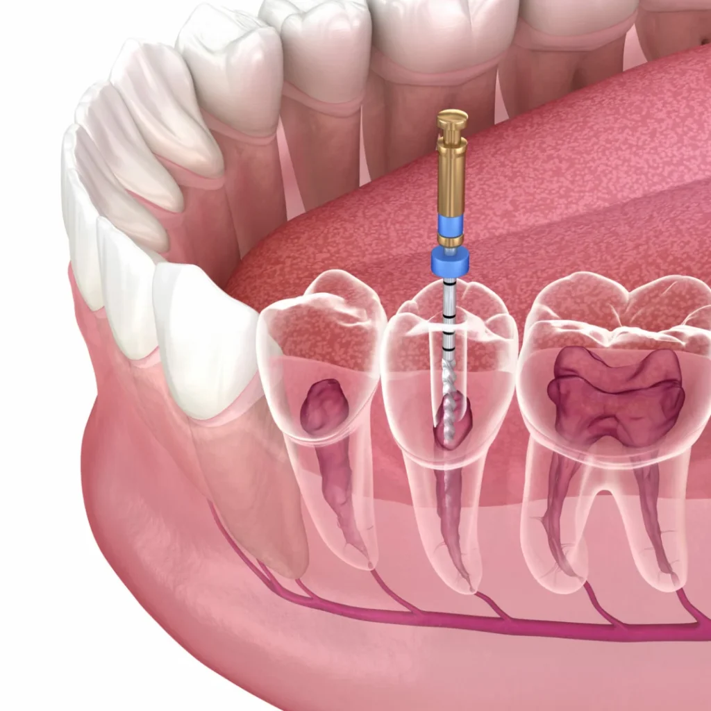 Root Canal Treatment