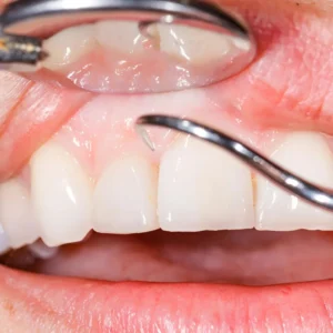 Biopsy Procedures