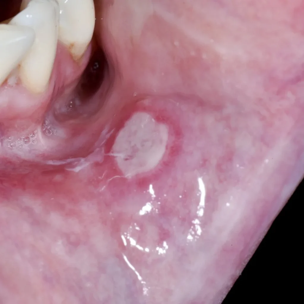 Mouth Ulcers