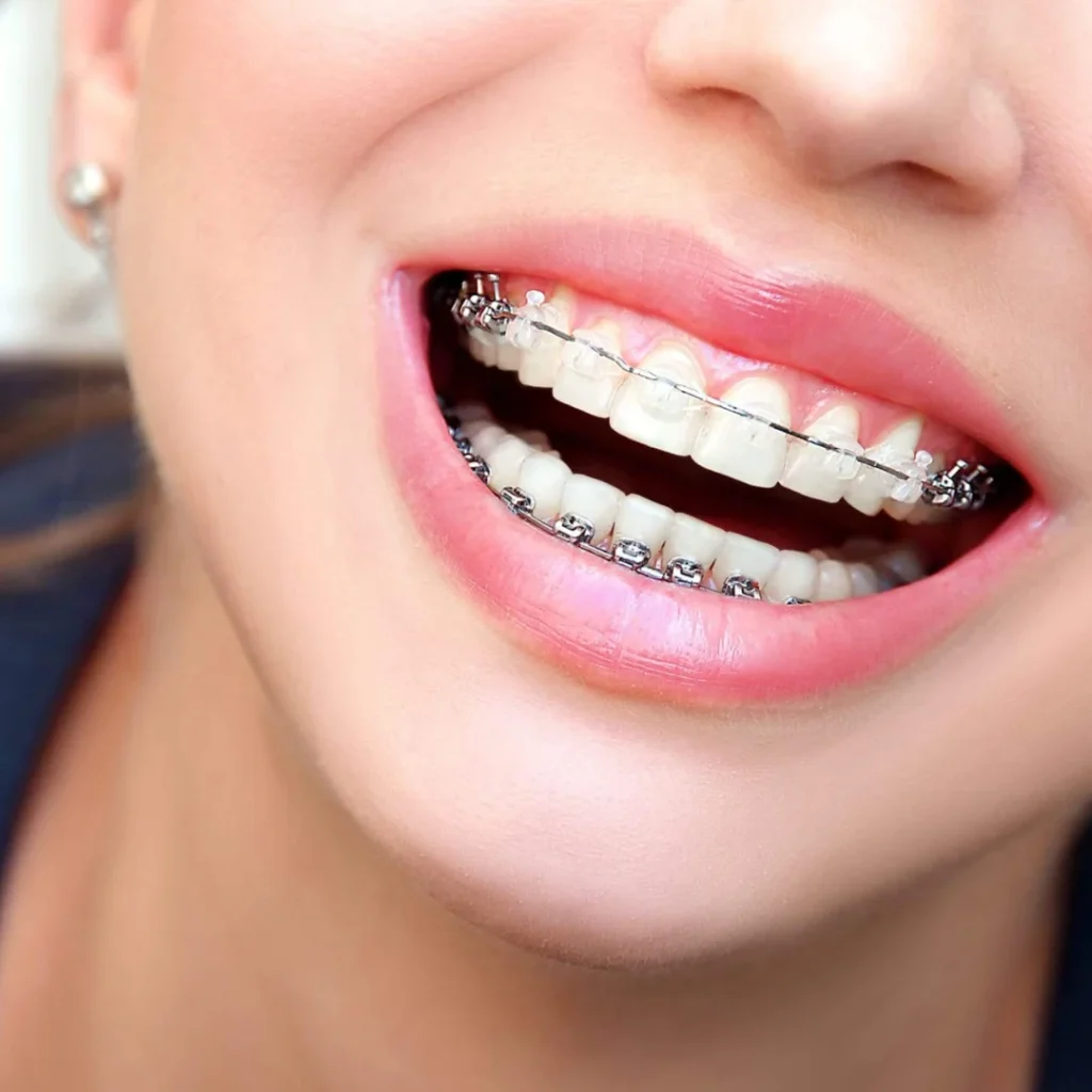 Invisible Braces Treatment