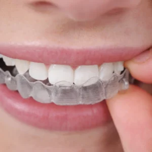 Clear Aligners