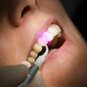 Root Canal Disinfection