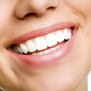 Teeth Whitening