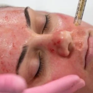 PRP/ vampire facials