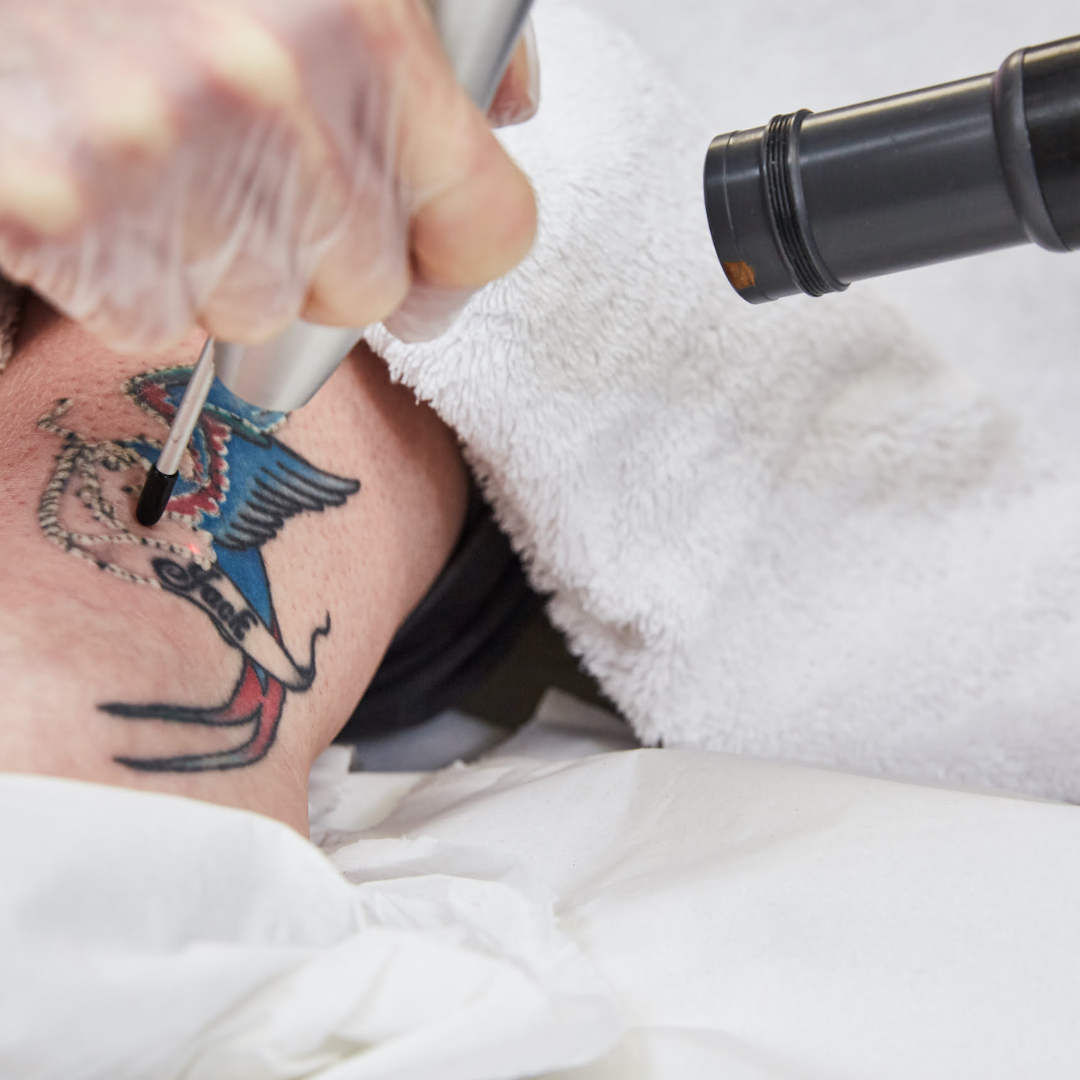 Laser tattoo removal