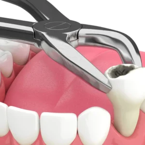 Tooth extraction