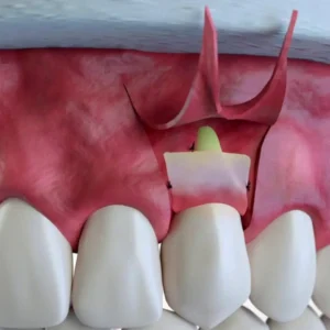 Gingival flap surgery