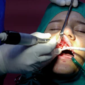 Apicoectomy