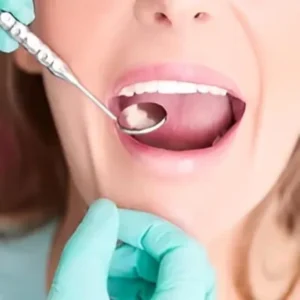 Tooth Decay Removal