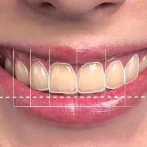 3d smile designing