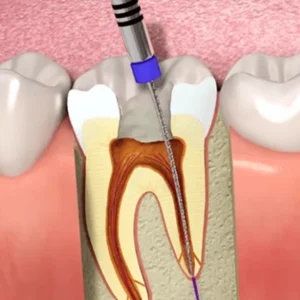 Painless RCTs