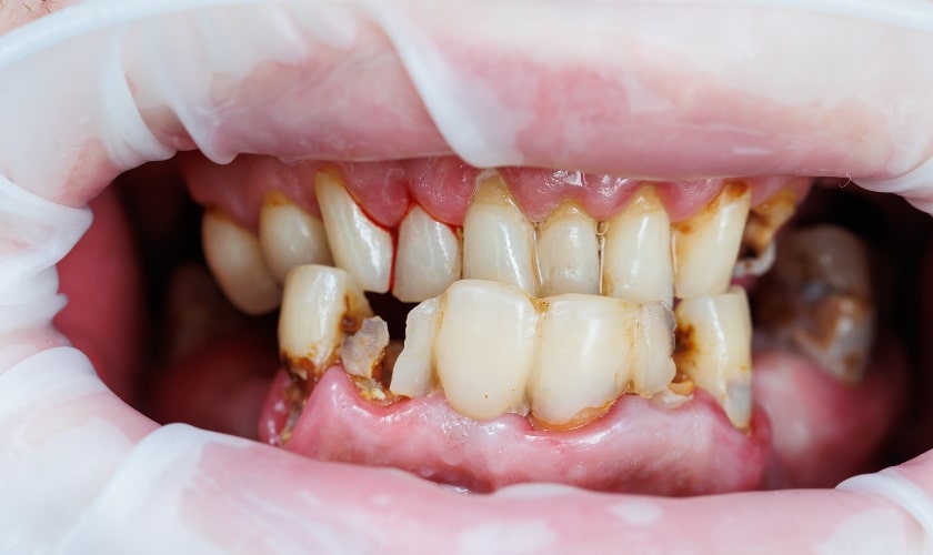 Gum Diseases