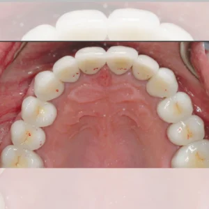 Final Adjustments and Follow-Up Care