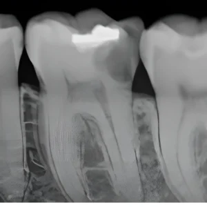Accessing the Tooth