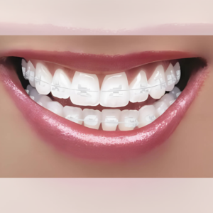 Ceramic Braces