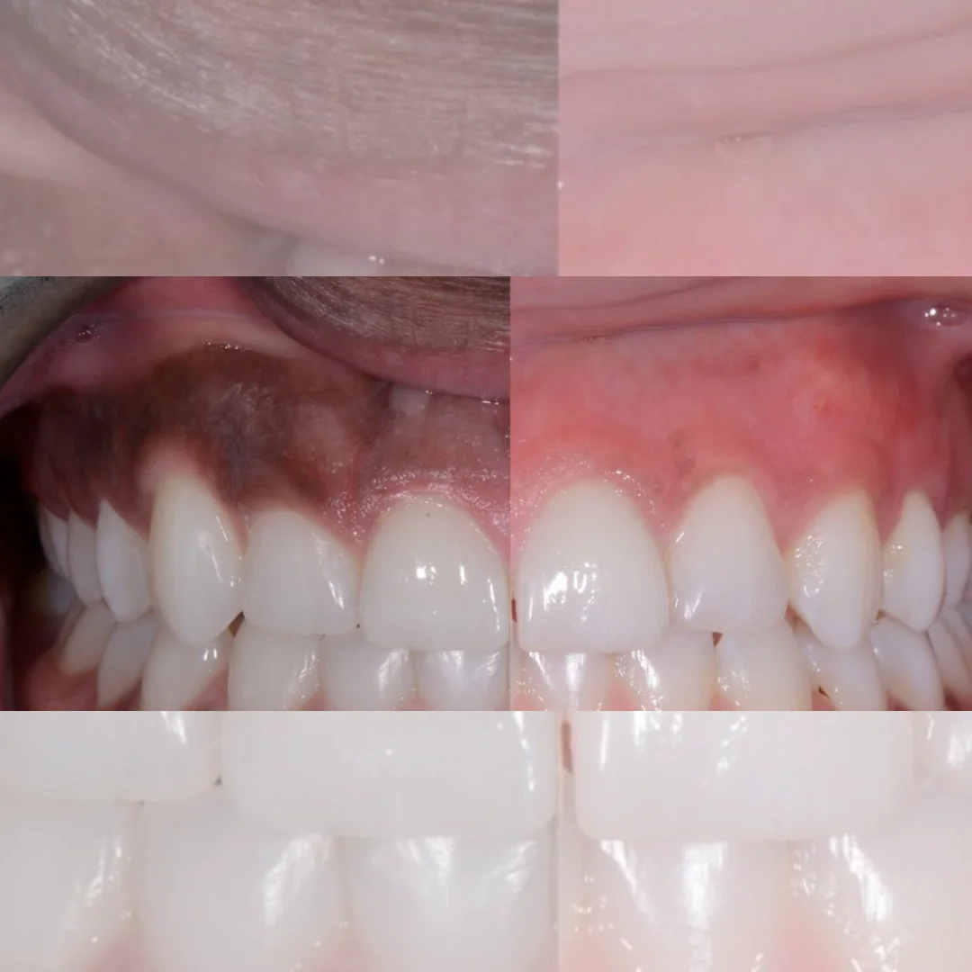 gums depigmentation